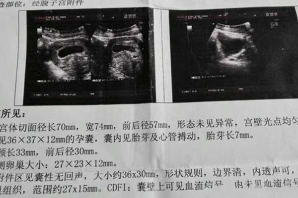 广州代孕捐卵补偿 广州私立医院做试管婴儿该怎么选择? ‘16周三维彩超怎么判